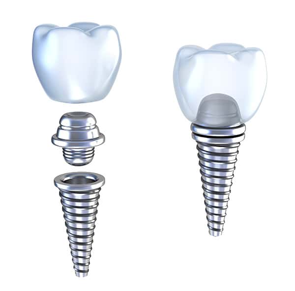 Dental Implants Marysville WA