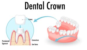 getting a dental crown