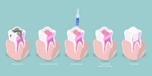 root canal