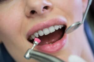 dental bonding Marysville WA
