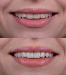 veneers Marysville WA