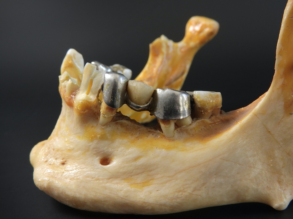 How Much Cost Dental Crowns and Bridges?