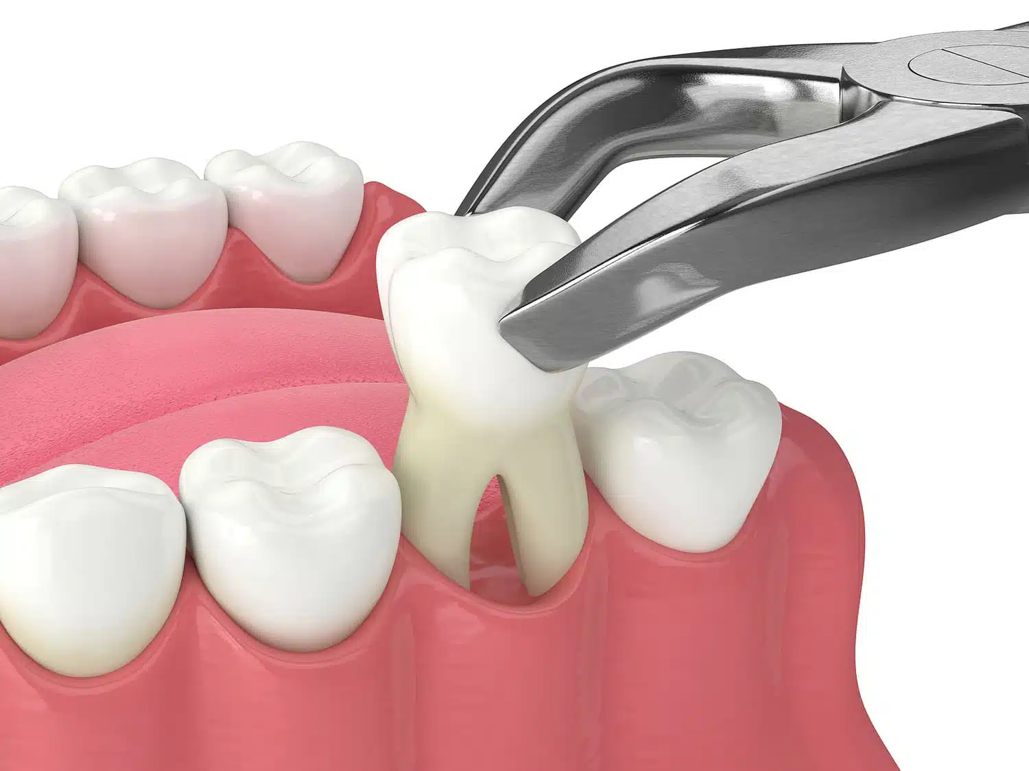 Marysville Tooth Extractions