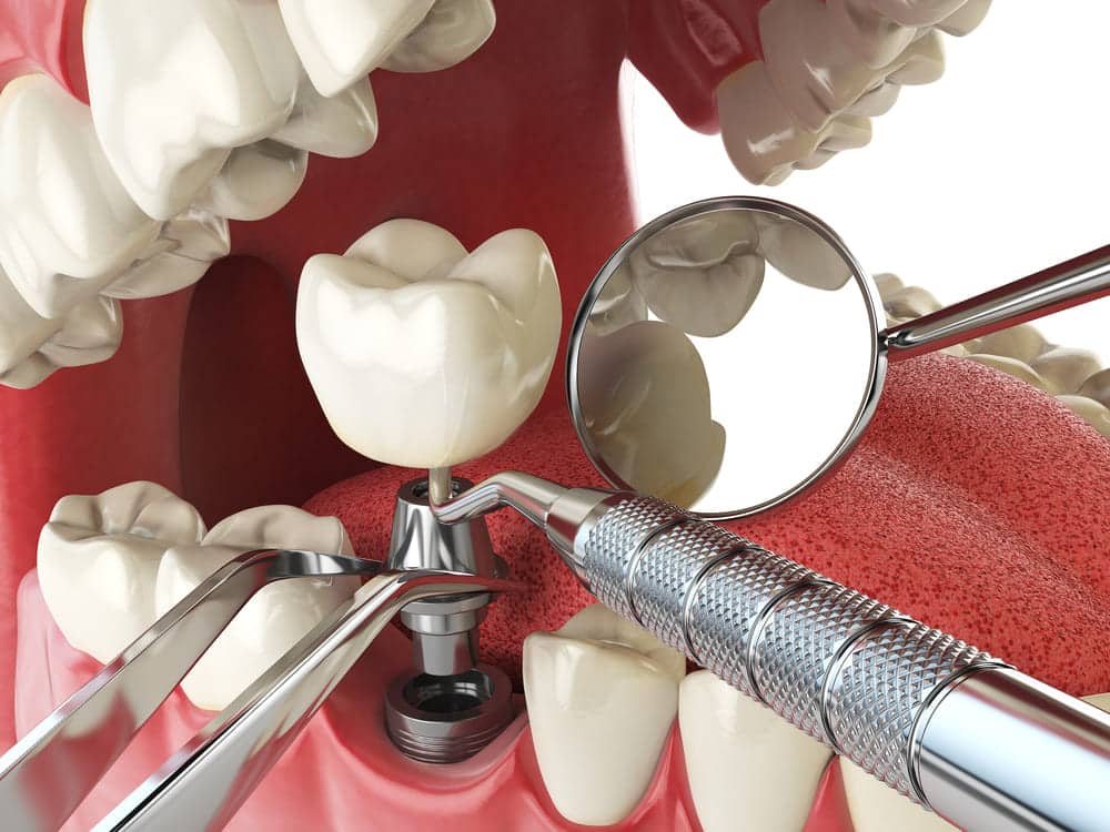 Marysville WA Dental Implants