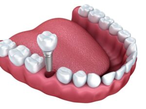 Which 3 types of dental implants are available?