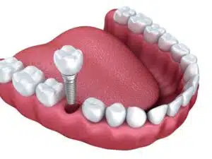 Which 3 types of dental implants are available?