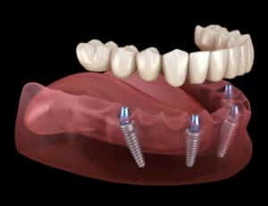 What are the different types of dental implants?
