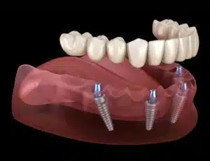 What are the different types of dental implants?