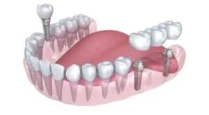 Guide to the 3 types of dental implants