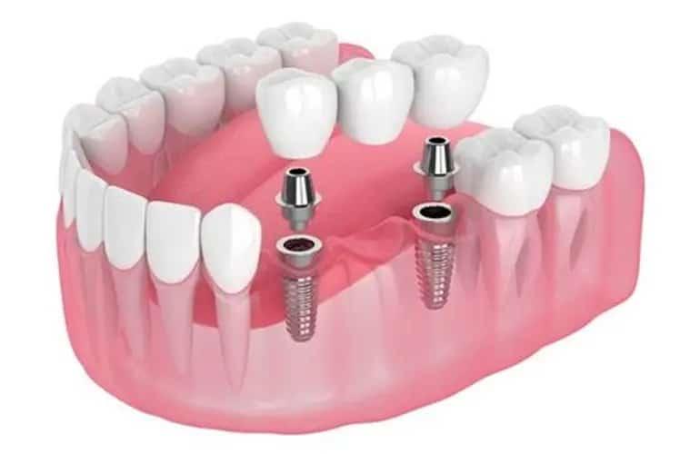 What are the 3 types of dental implants