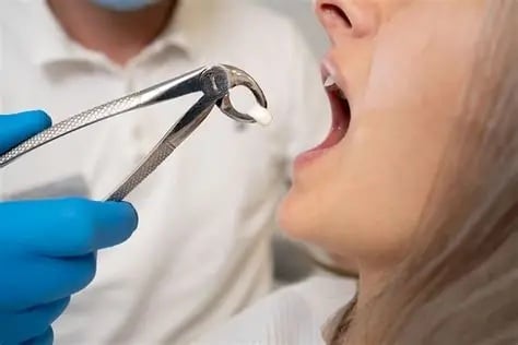 How Long Does a Tooth Extraction Take?