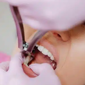 Tooth Extraction Fees