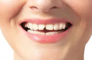 Emergency for Chipped Tooth