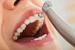 Woman having dental checkup showing how long is a dental cleaning