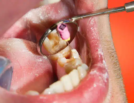 Illustration showing how to prevent root canal with proper oral hygiene and early dental care