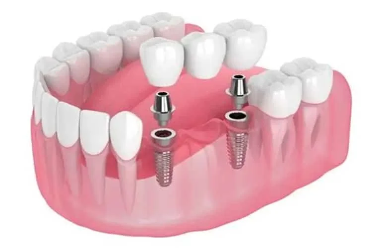 What are the 3 types of dental implants