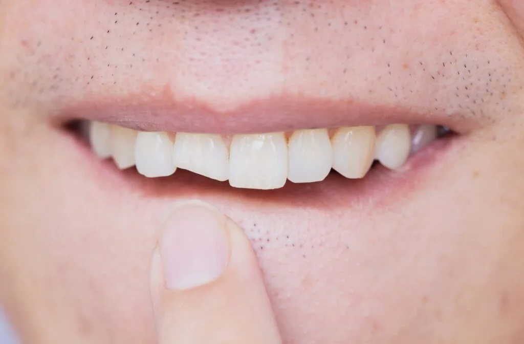 Is a Chipped Tooth a Dental Emergency
