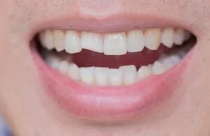 Dental Emergency Chipped Tooth
